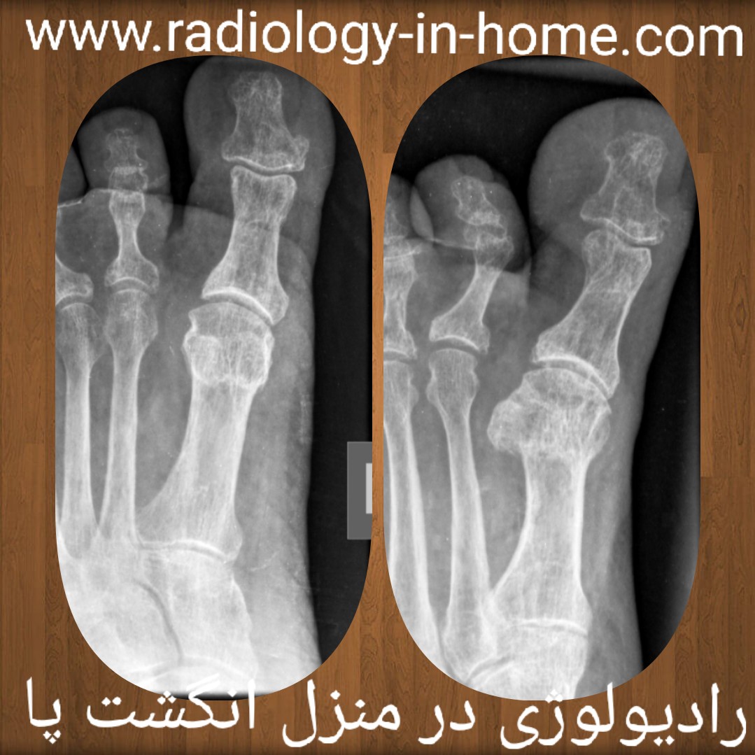 رادیولوژی در منزل انگشت پا
