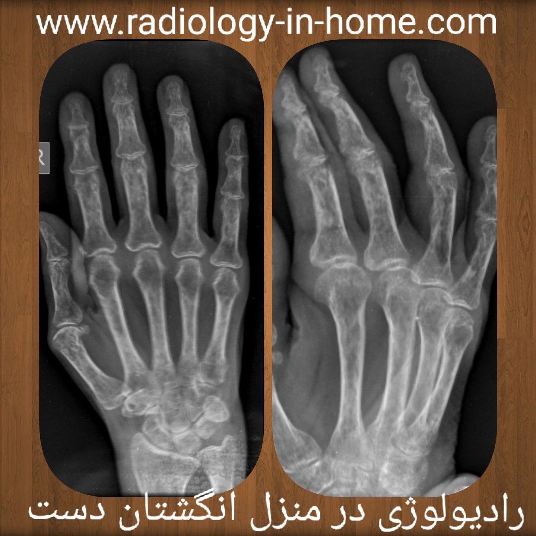 رادیولوژی در منزل انگشا دست