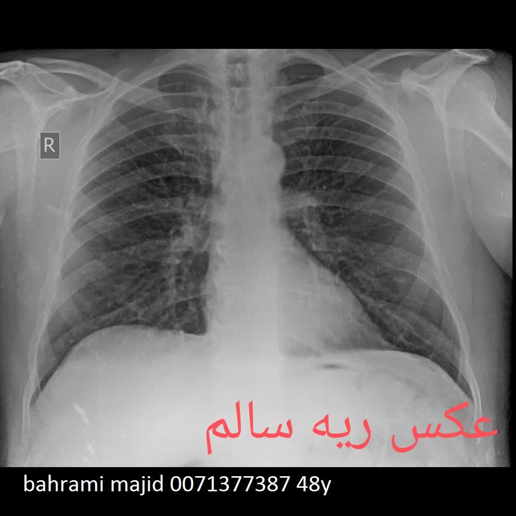 رادیولوژی در منزل ریه ناسالم و سالم انسان،رادیولوژی در منزل تهران