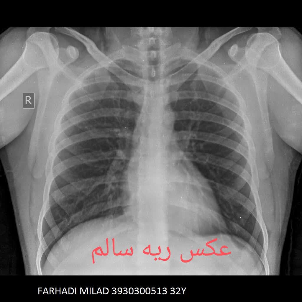 رادیولوژی در منزل عکس ریه سالم و ناسالم انسان،رادیولوژی در منزل تهران