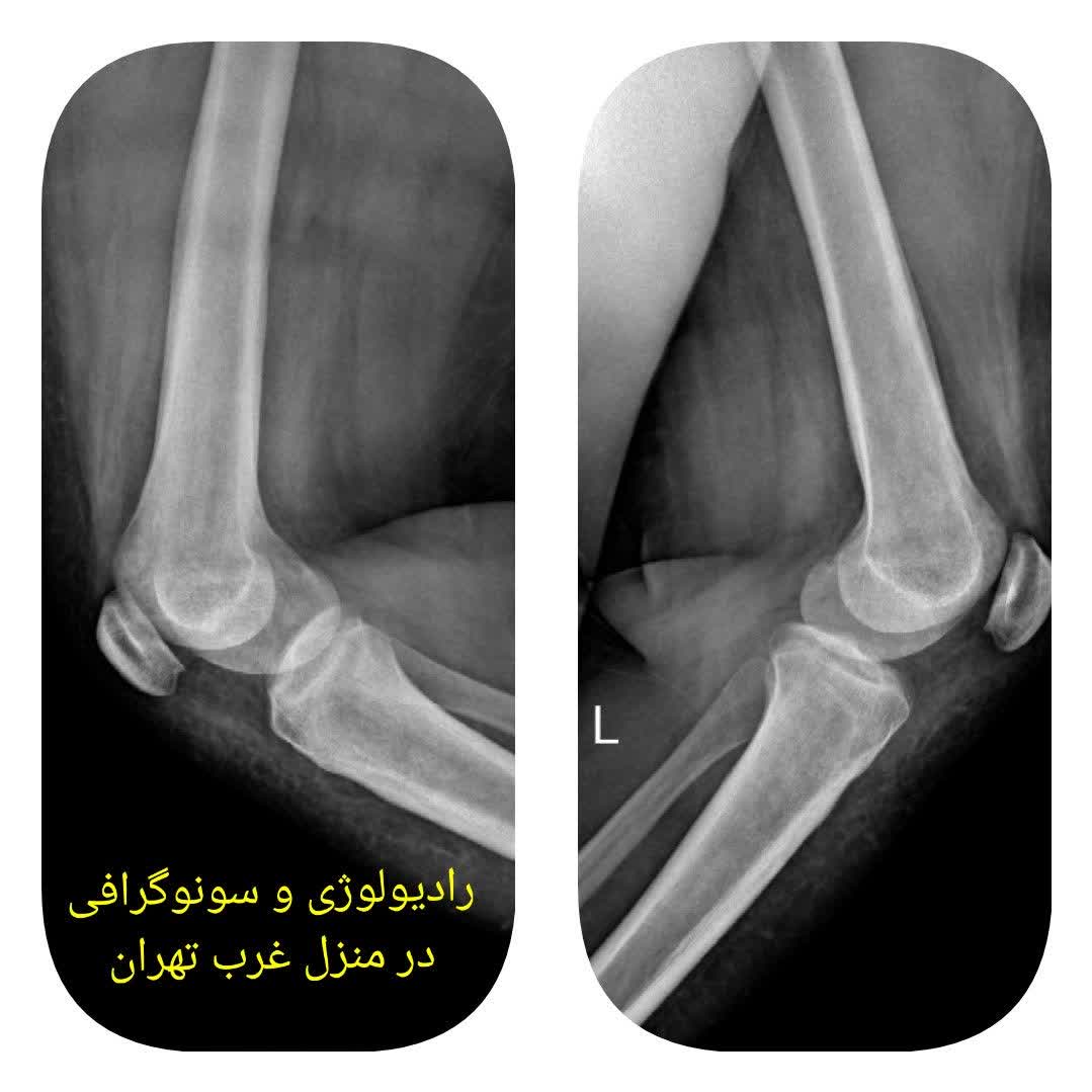 رادیولوژی در منزل غرب تهران از لگن ران زانو ساق پا مچ و انگشت پا مچ دست شانه بازو کتف ریه دنده گردن و کمر