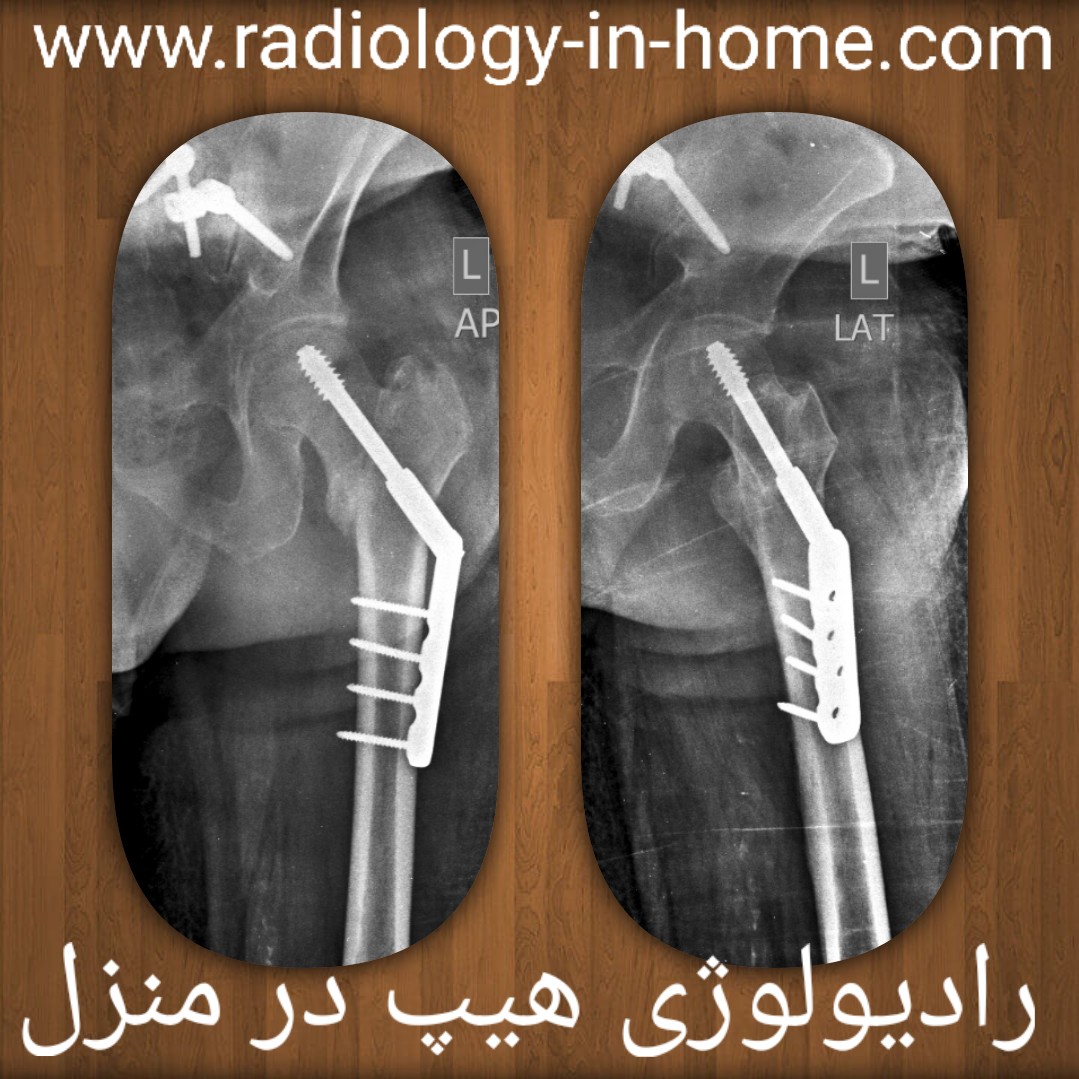 رادیولوژی در منزل جهت شکستگی لگن و ران در تهران
