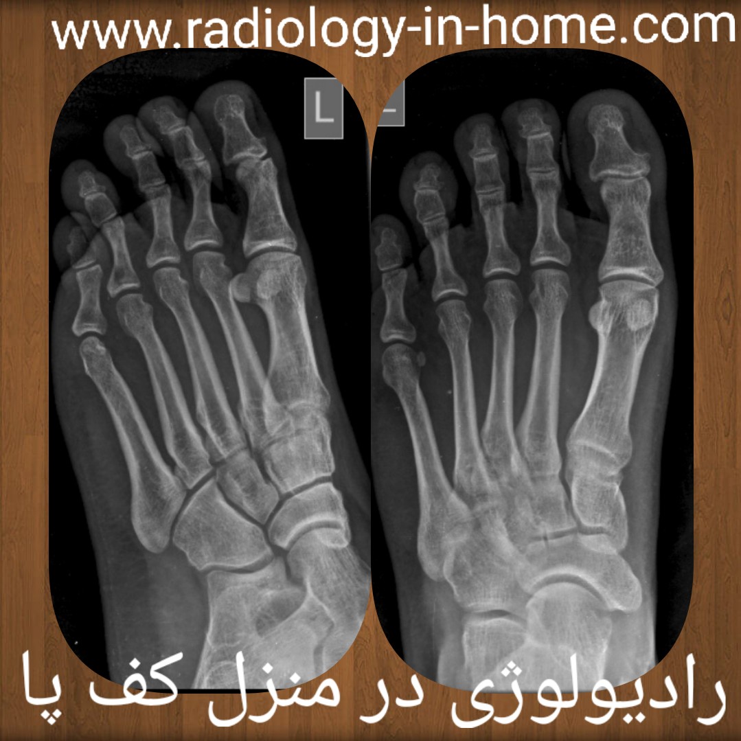 رادیولوژی در منزل کف پا
