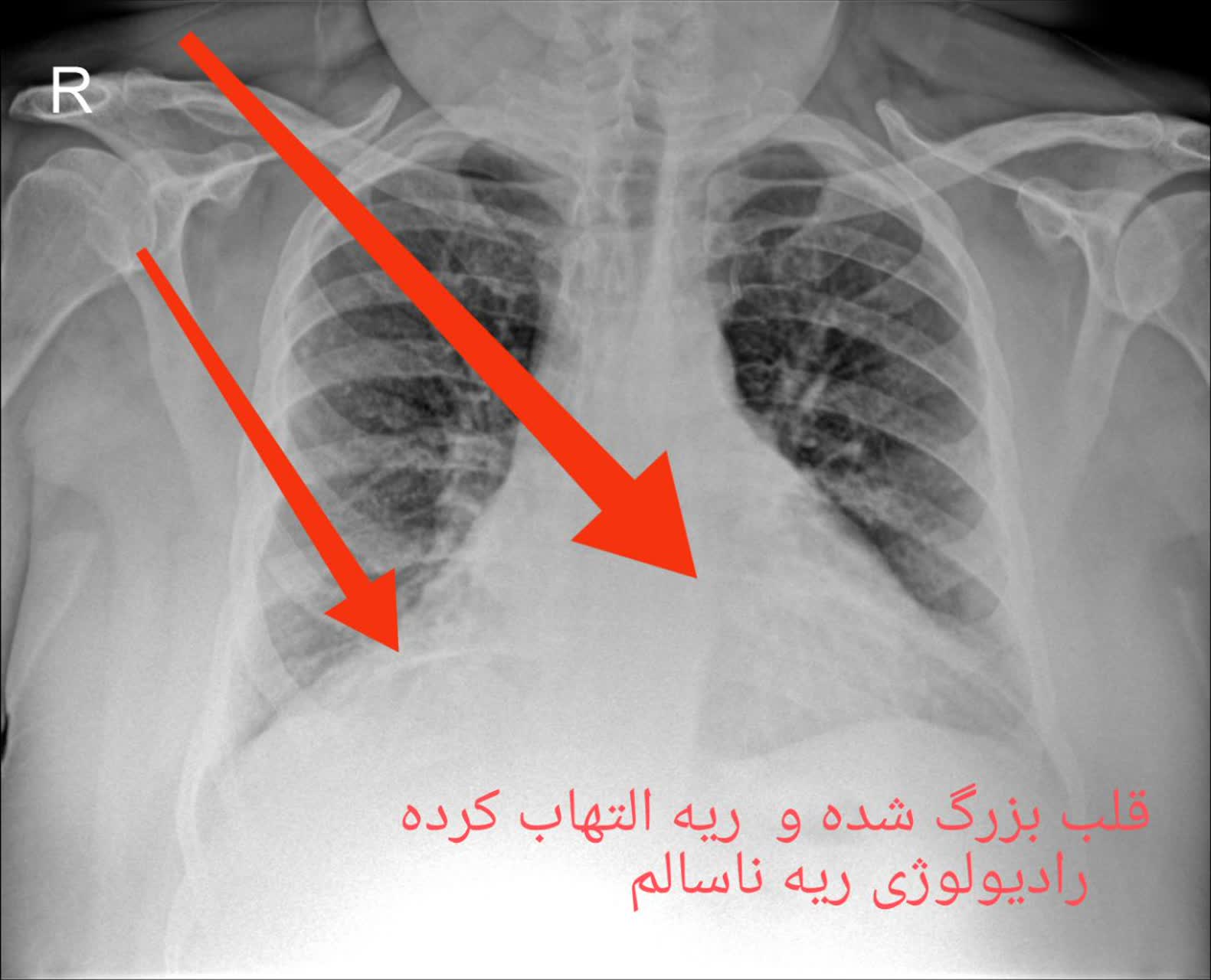 رادیولوژی ریه سالم و ناسالم در منزل تهران،رادیولوژی در منزل تهران
