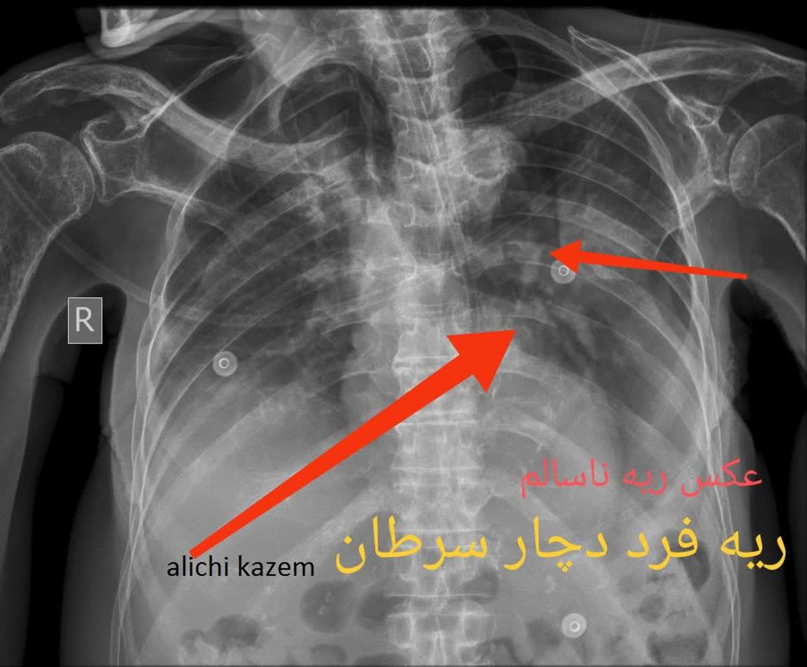 رادیولوژی ریه عکس سالم و ناسالم،رادیولوژی در منزل تهران