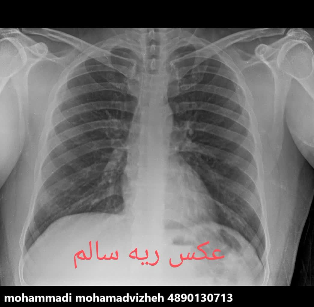 رادیولوژی ریه ناسالم و سالم در منزل،رادیولوژی در منزل تهران