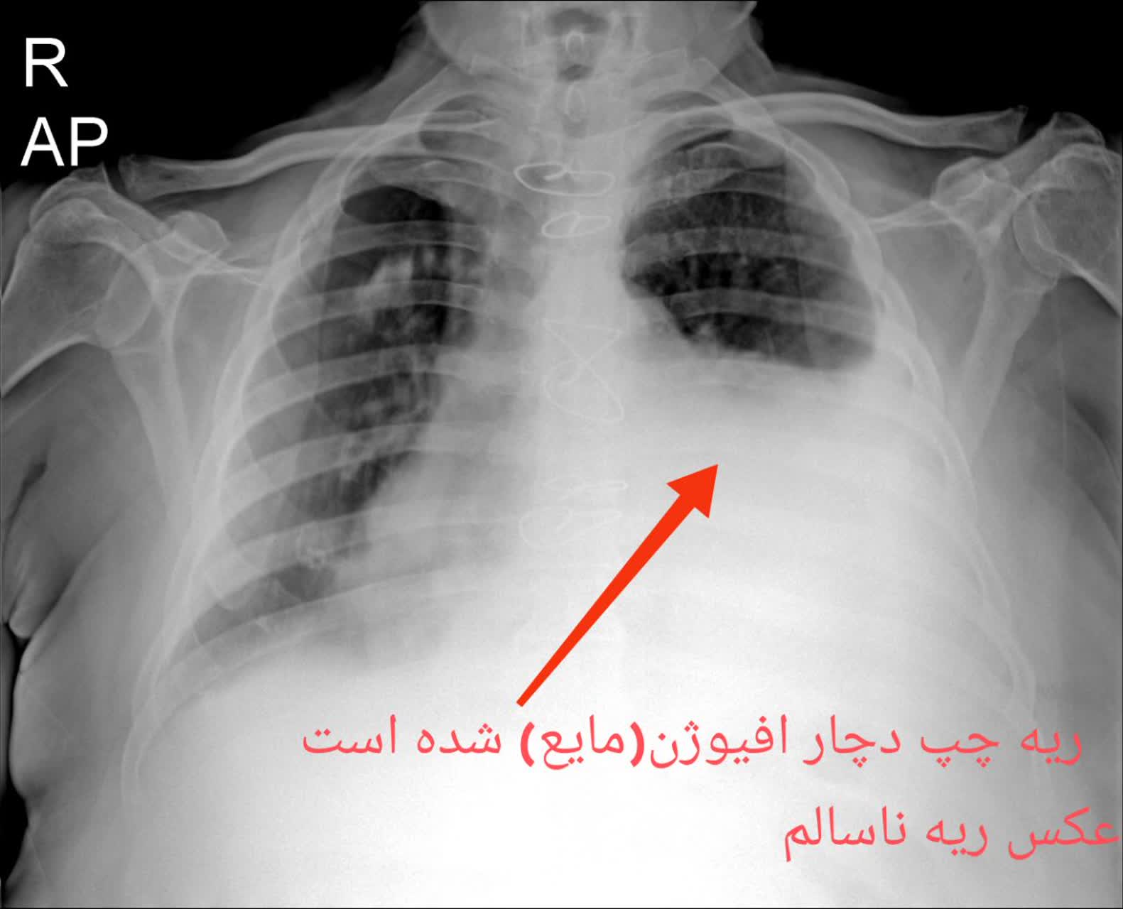 رادیولوژی ریه ی ناسالم انسان،رادیولوژی در منزل تهران