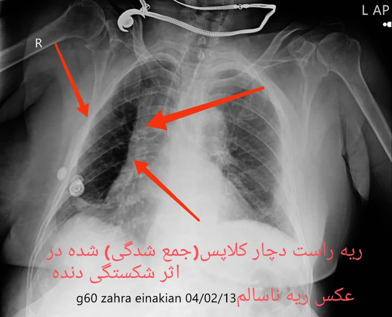 رادیولوژی عکس ریه سالم و ناسالم در منزلر تهران،رادیولوژی در منزل تهران