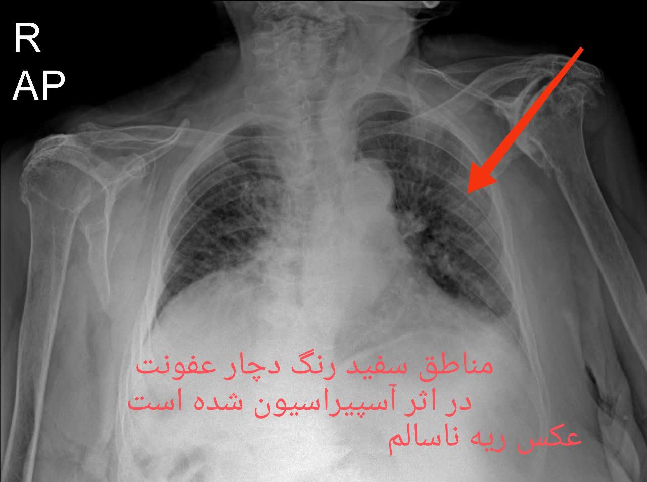 ریه ی ناسالم و سالم،رادیولوژی در منزل تهران