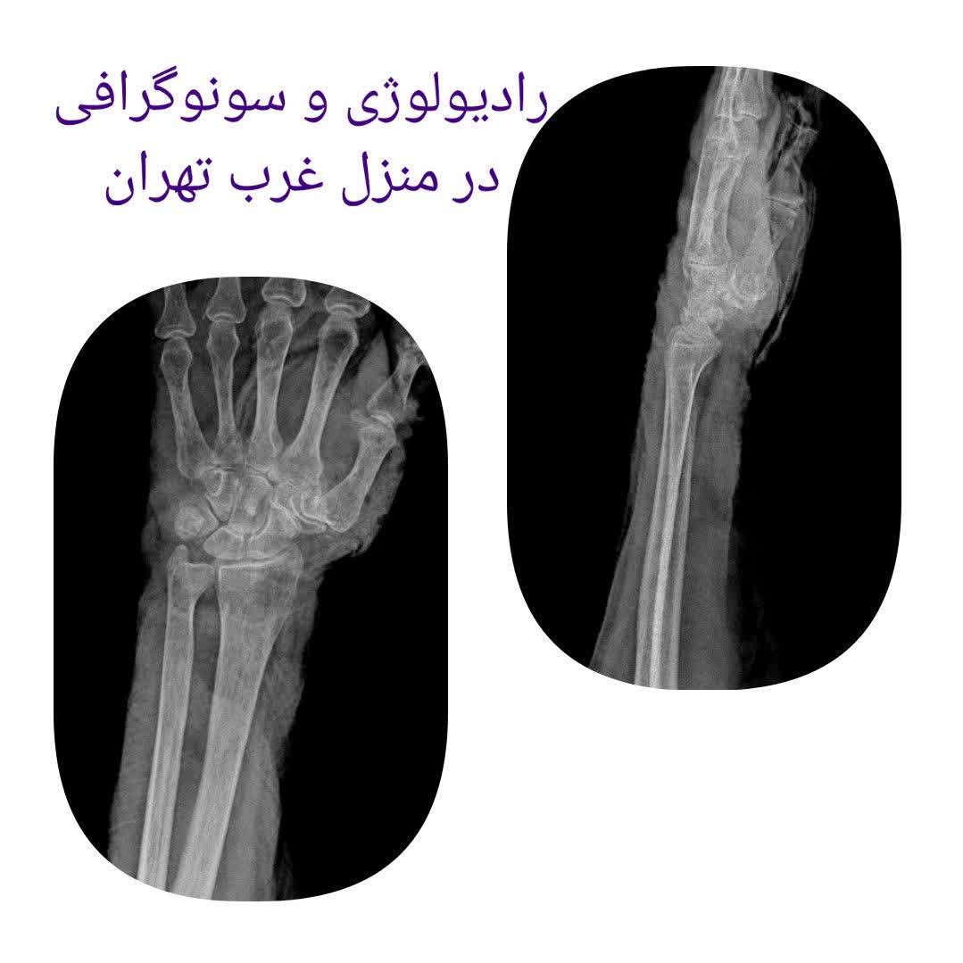 سونوگرافی در منزل غرب تهران از شکم و لگن ،کلیه مثانه مجاری ادراری،پروستات و بیضه ، کالرداپلر شریانی وریدی جهت تشخیص لخته