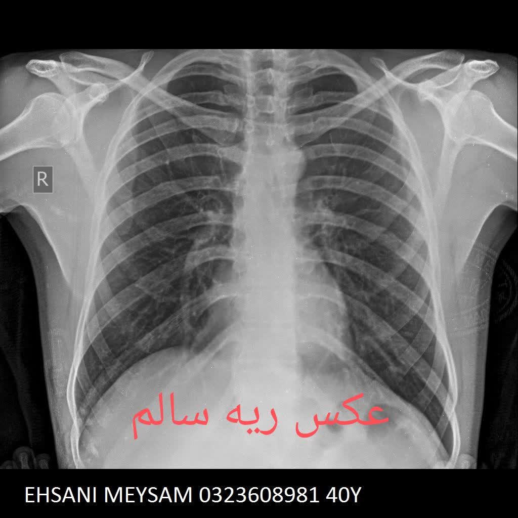 عکس رادیولوژی در منزل ریه سالم و ناسالم انسان،رادیولوژی در منزل تهران
