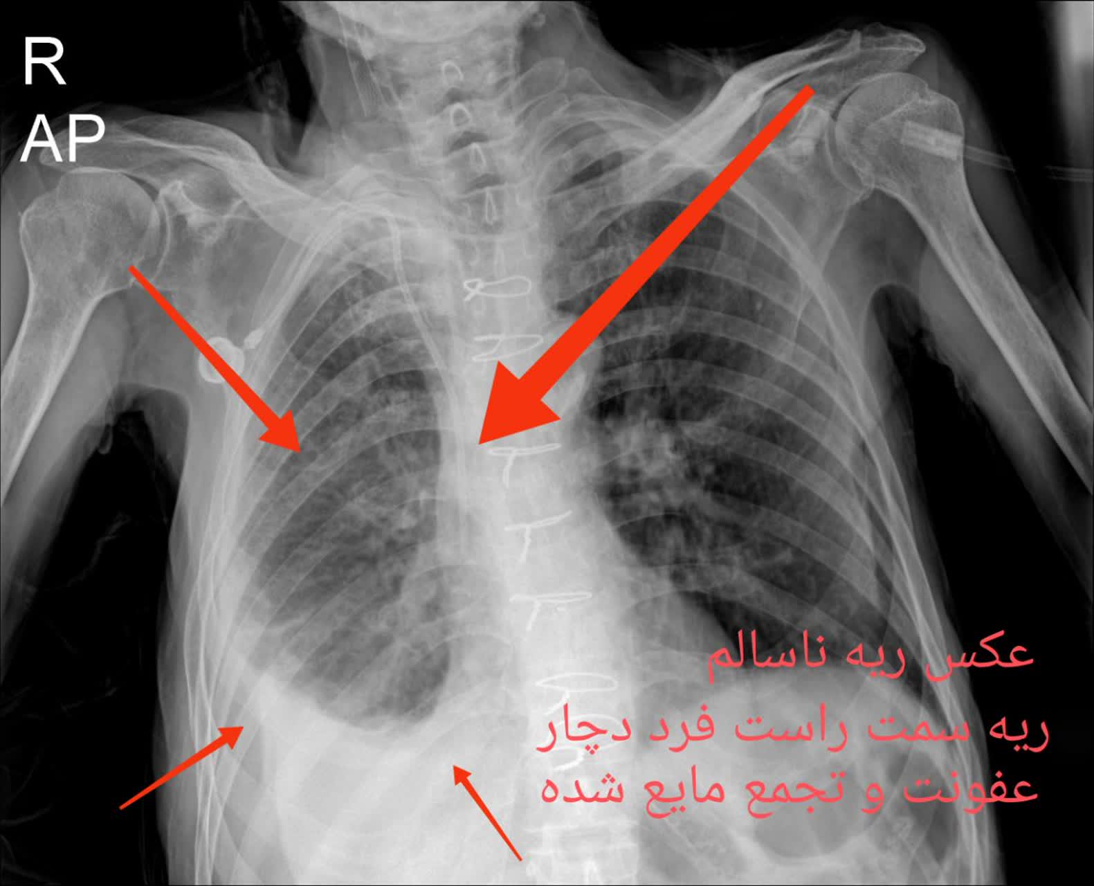 عکس رادیولوژی در منزل ریه سالم و ناسالم تهران کرج،رادیولوژی در منزل تهران