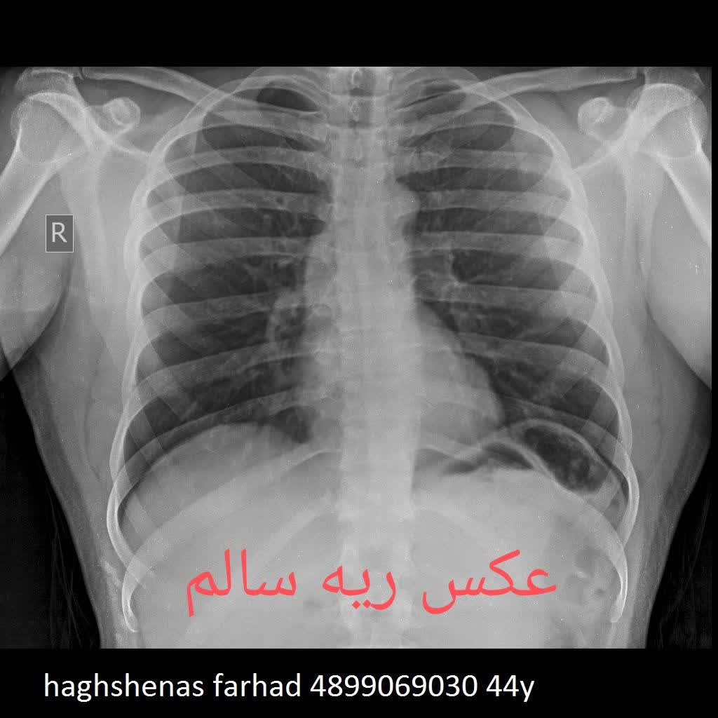 عکس رادیولوژی ریه ی سالم و ناسالم در منزل،رادیولوژی در منزل تهران