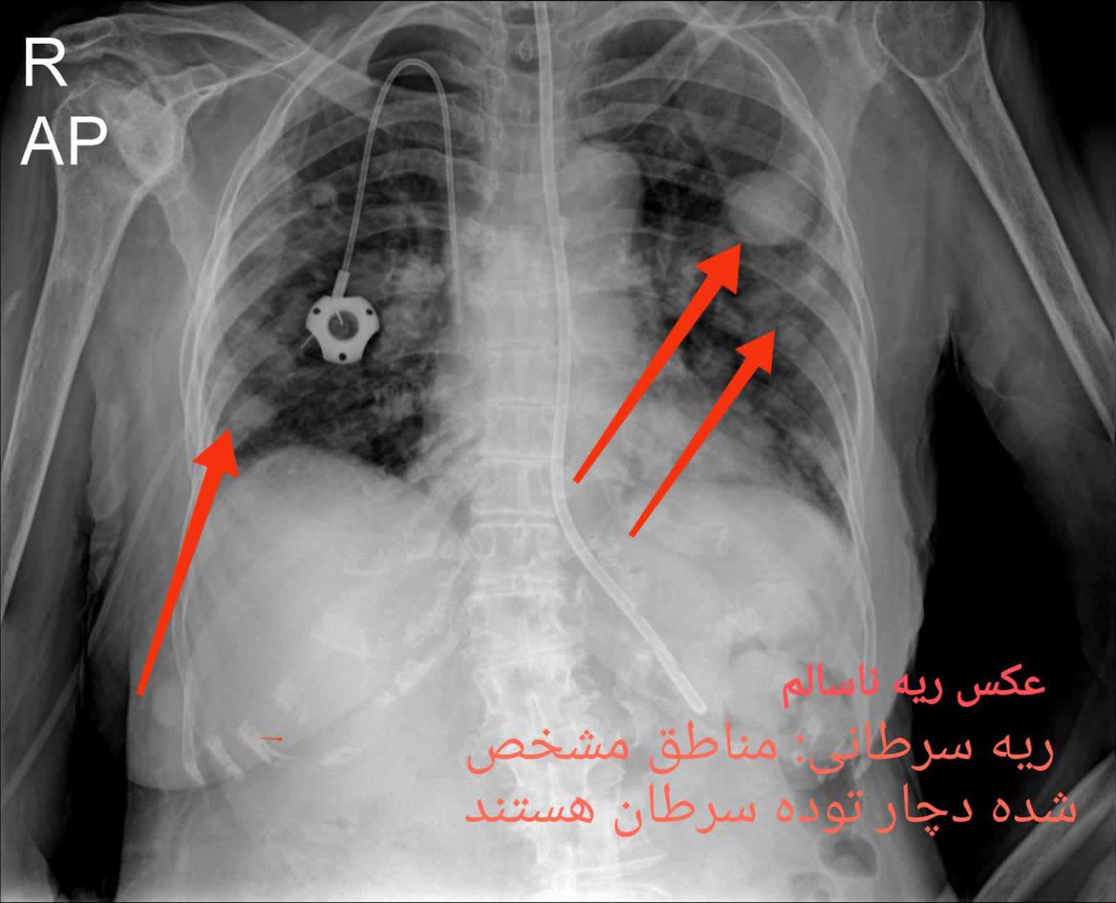 عکس ریه رادیولوژی سالم و ناسالم،رادیولوژی در منزل تهران