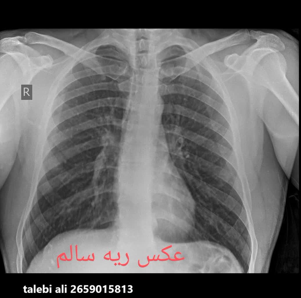 عکس ریه سالم و ناسالم انسان در منزل،رادیولوژی در منزل تهران