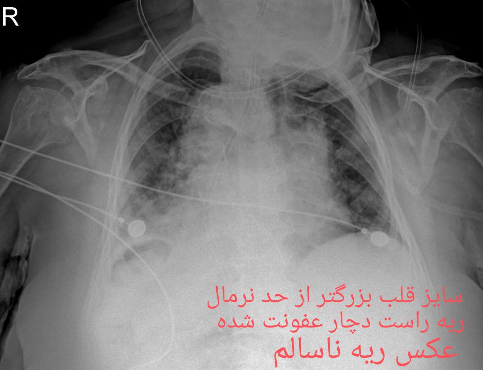 عکس ریه سالم و ناسالم در منزل تهران،رادیولوژی در منزل تهران