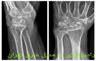 رادیولوژی در منزل مچ پا و مچ دست در تهران و کرج