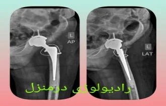 عکس رادیولوژی پرتابل و سیار در منزل 