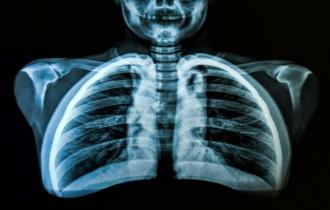 رادیولوژی در منزل از ریه یا قفسه سینه 