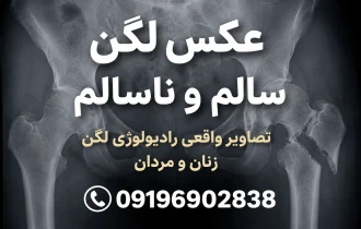 عکس لگن سالم و ناسالم | تصاویر واقعی رادیولوژی لگن زن و مرد